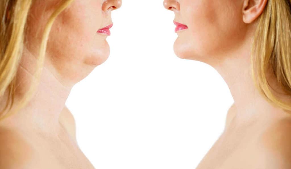Double Chin treatment Greater London (Ealing) before and after results