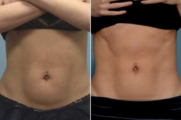 body sculpting FAQs Greater London (Ealing)