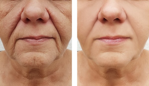Learn more about Morpheus8 Treatment Greater London (Ealing) today!
