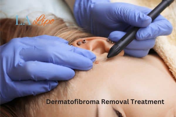 Dermatofibroma Removal Treatment Greater London (Ealing)
