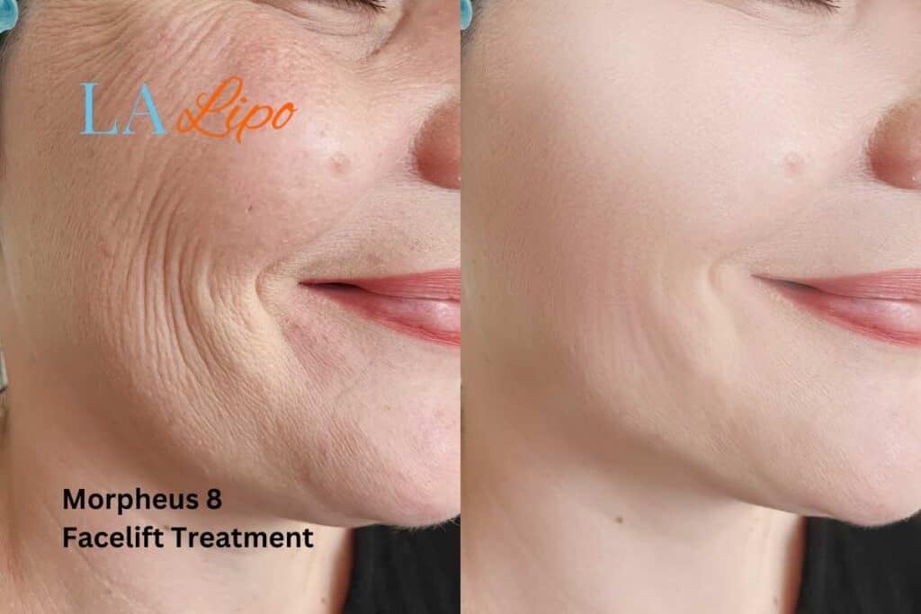 Morpheus8 Treatment Greater London (Ealing) for flawless skin! Call us today!