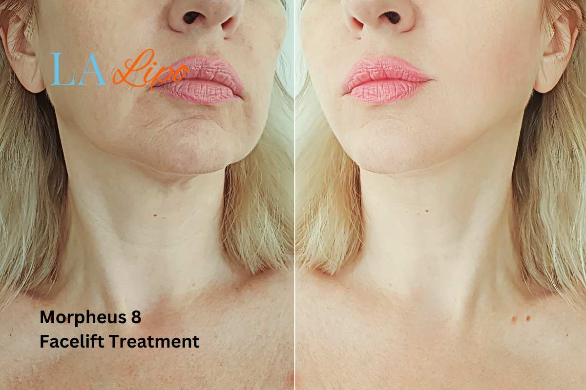 Turn back time with Morpheus8 Treatment Greater London (Ealing)