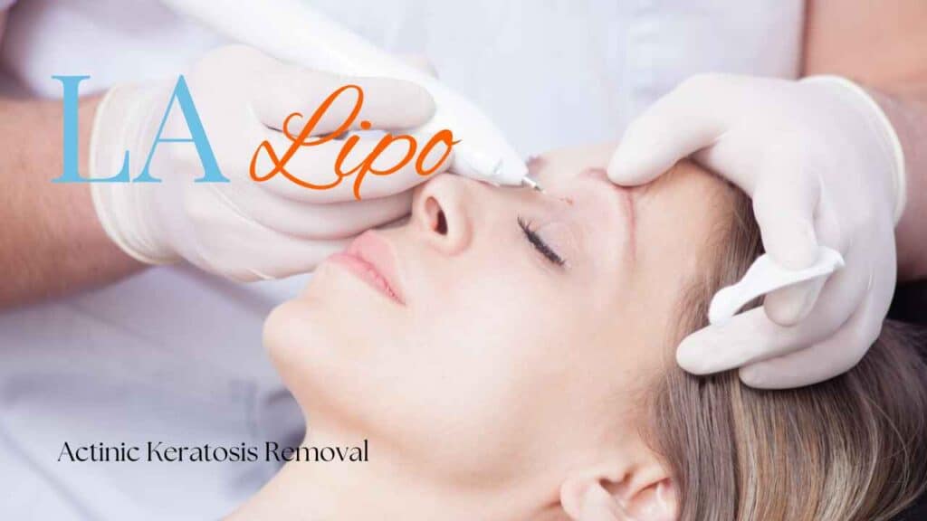actinic keratosis removal Greater London (Ealing)