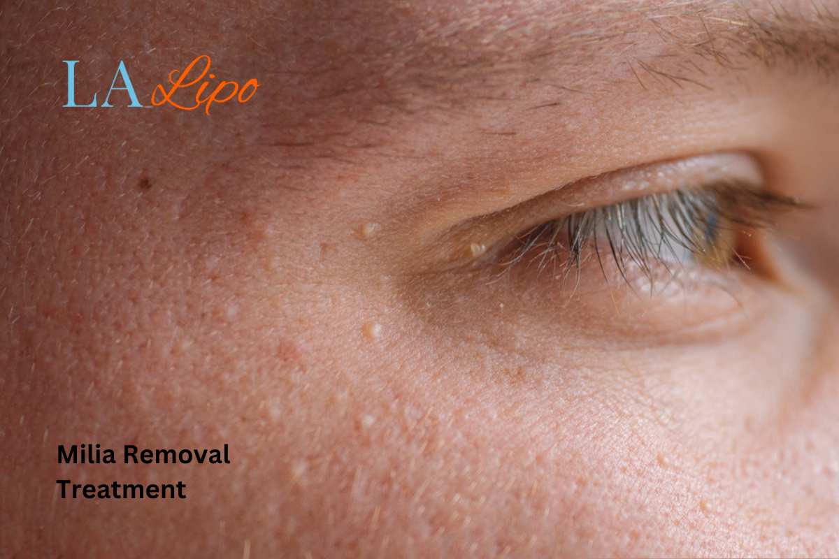 Cryopen Milia Removal: Is It the Easiest and Safest Option Greater London (Ealing)?