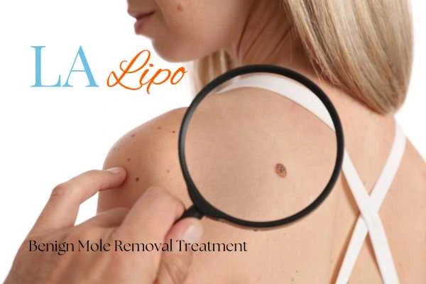 Why getting moles removed Greater London (Ealing) can boost your confidence!
