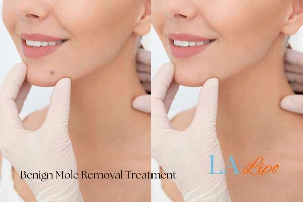 woman's before and after mole removal Greater London (Ealing) results
