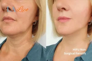 hi-fu for wrinkles Greater London (Ealing) before and after results