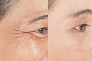 Before and after results of woman - HI-fu wrinkles reduction treatment Greater London (Ealing)