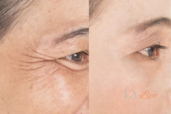 Before and after results of woman - HI-fu wrinkles reduction treatment Greater London (Ealing)