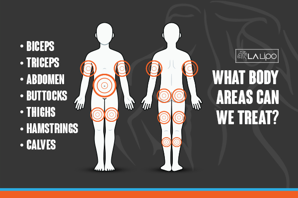 Graphic to show areas you can have LA-EMS Body Sculpting Greater London (Ealing) treatment.