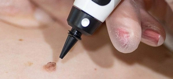 skin tag removal using cryopen Greater London (Ealing)
