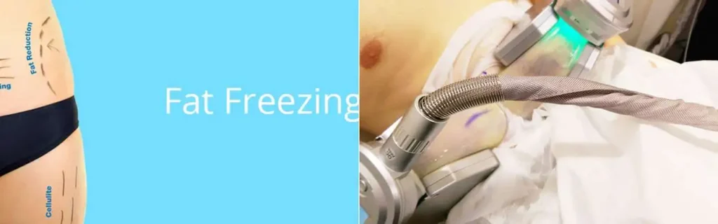 Fat freezing Greater London (Ealing) on multiple areas of the body