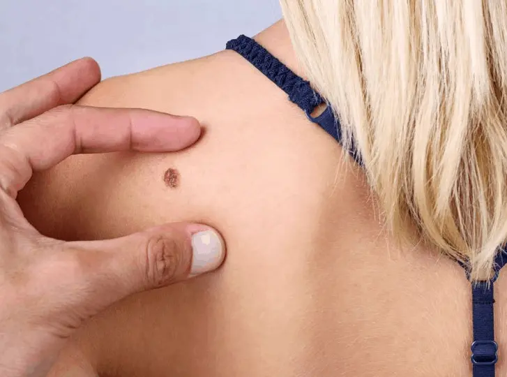 woman having mole removal Greater London (Ealing) consultation before treatment.