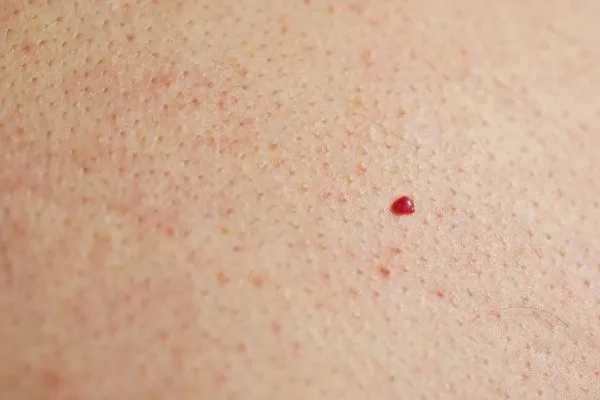 close up of a cherry angioma Greater London (Ealing)