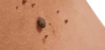 image of a skin tag Greater London (Ealing)