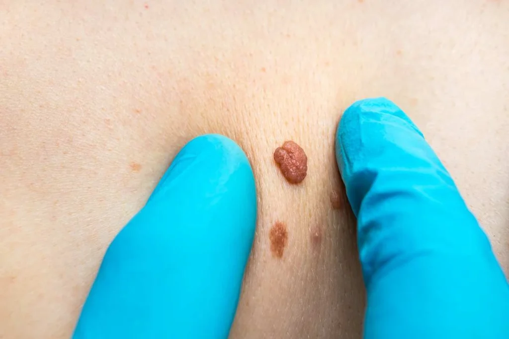 Consultant examining a skin tag Greater London (Ealing)
