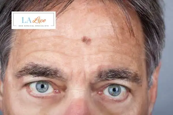 Solar Lentigo Removal Greater London (Ealing) image of man with mark on his forehead