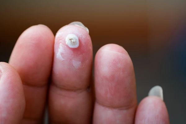 wart on person finger - cryotherapy to treat from LA LIPO Greater London (Ealing)