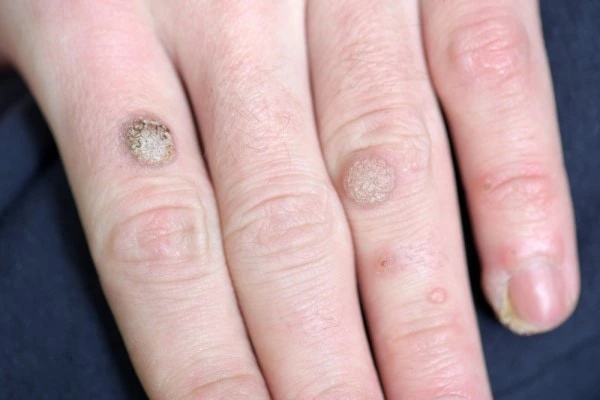 photo of warts on person hand - see wart removal Greater London (Ealing) from LA LIPO