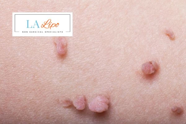 Does cryopen skin tag removal Greater London (Ealing) hurt? Find out now call our team today!