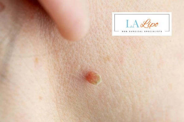 Book skin tag removal Greater London (Ealing) today speak to our team now!