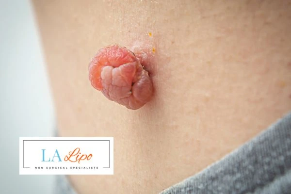 Interested in skin tag removal Greater London (Ealing)? Concerned about the pain? Find out more today!