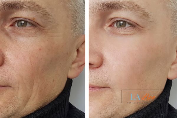 See the amazing results of Morpheus8 Treatment Greater London (Ealing)!