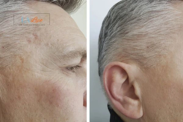 Mens Before & After Morpheus 8 Results Greater London (Ealing)