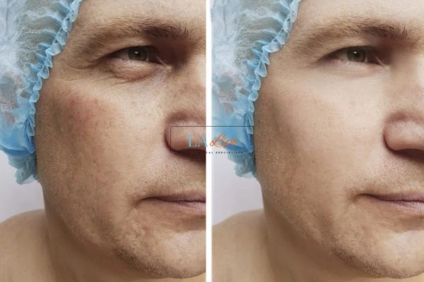 Before and after Morpheus 8 Results Greater London (Ealing)