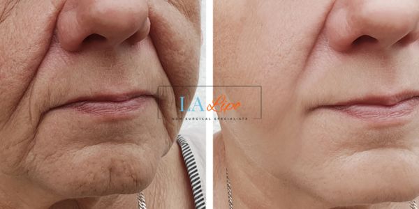 Older lady deeper wrinkle reduction - LA LIPO Morpheus 8 Results Greater London (Ealing)