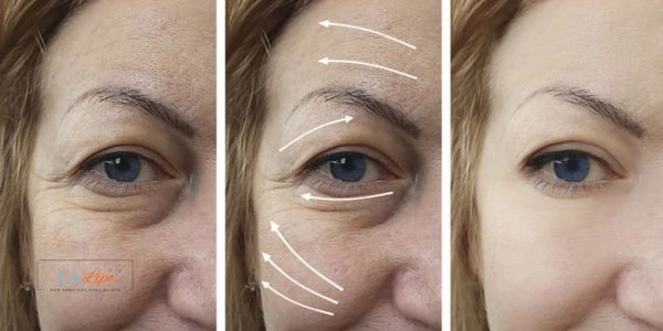 Amazing eye lift Morpheus 8 results Greater London (Ealing)