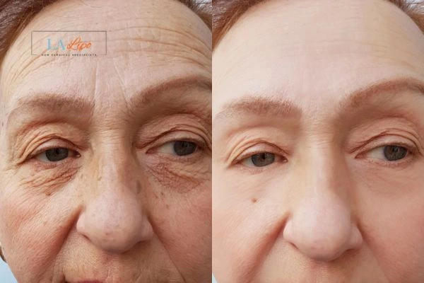 The powerful benefits of Morpheus8 Treatment Greater London (Ealing) - Call Our team today!