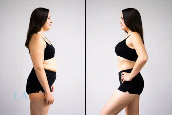 Picture of womans before and after using LA-EMS body sculpting to improve her core strength Greater London (Ealing)