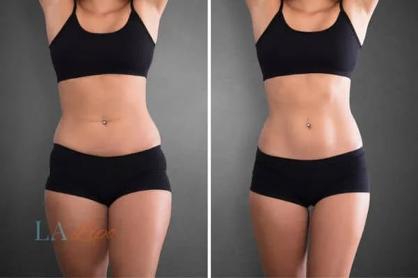 before and after results of non-surgical treatment to help a woman's body image and mental health Greater London (Ealing)