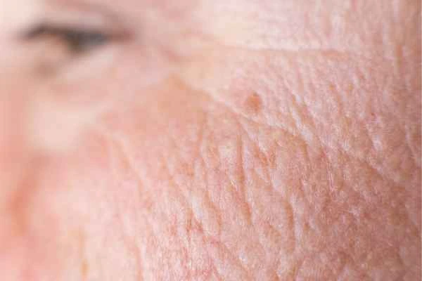 close up picture of a woman's face showing an age spot Greater London (Ealing)