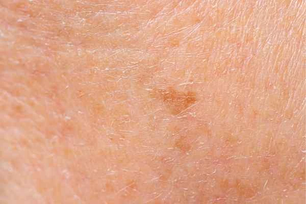 close up picture of age spots Greater London (Ealing)