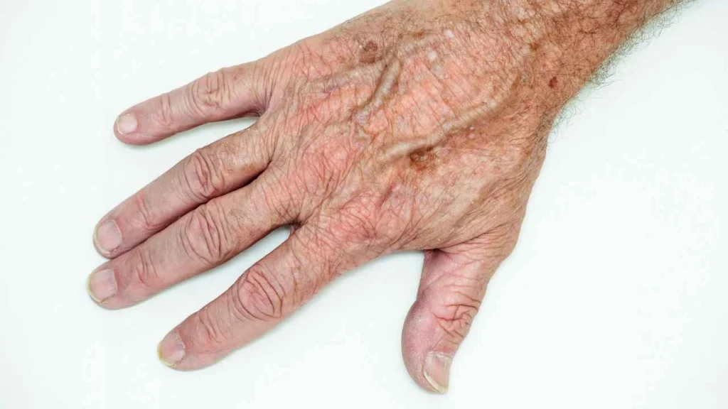 Male hand showing age spot Greater London (Ealing)
