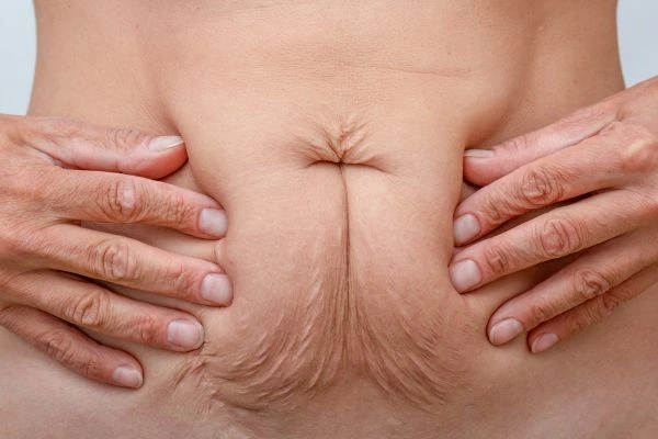 Image of a woman's stomach with loose skin - example of skin tightening Greater London (Ealing) options