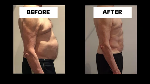 What Symptoms Can Diastasis Recti Cause in Men? Weak Core, Back Pain and Poor Posture Greater London (Ealing)